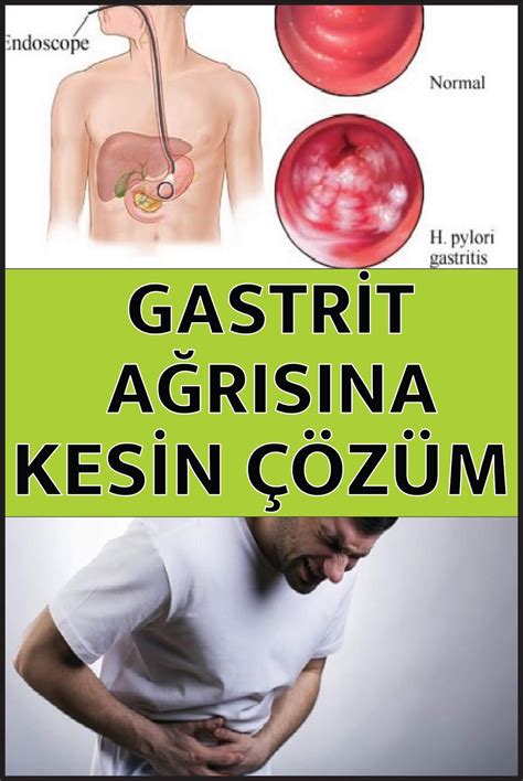 <strong>Gastrit</strong> me një funksion të reduktuar sekretore ndodh bloating dhe një ndjenjë e gravitetit. . Gastrit ne stomak